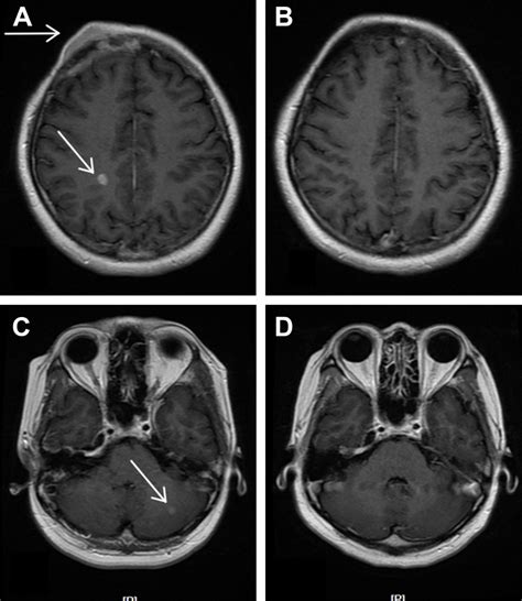 slice thickness brain metastatic lesions